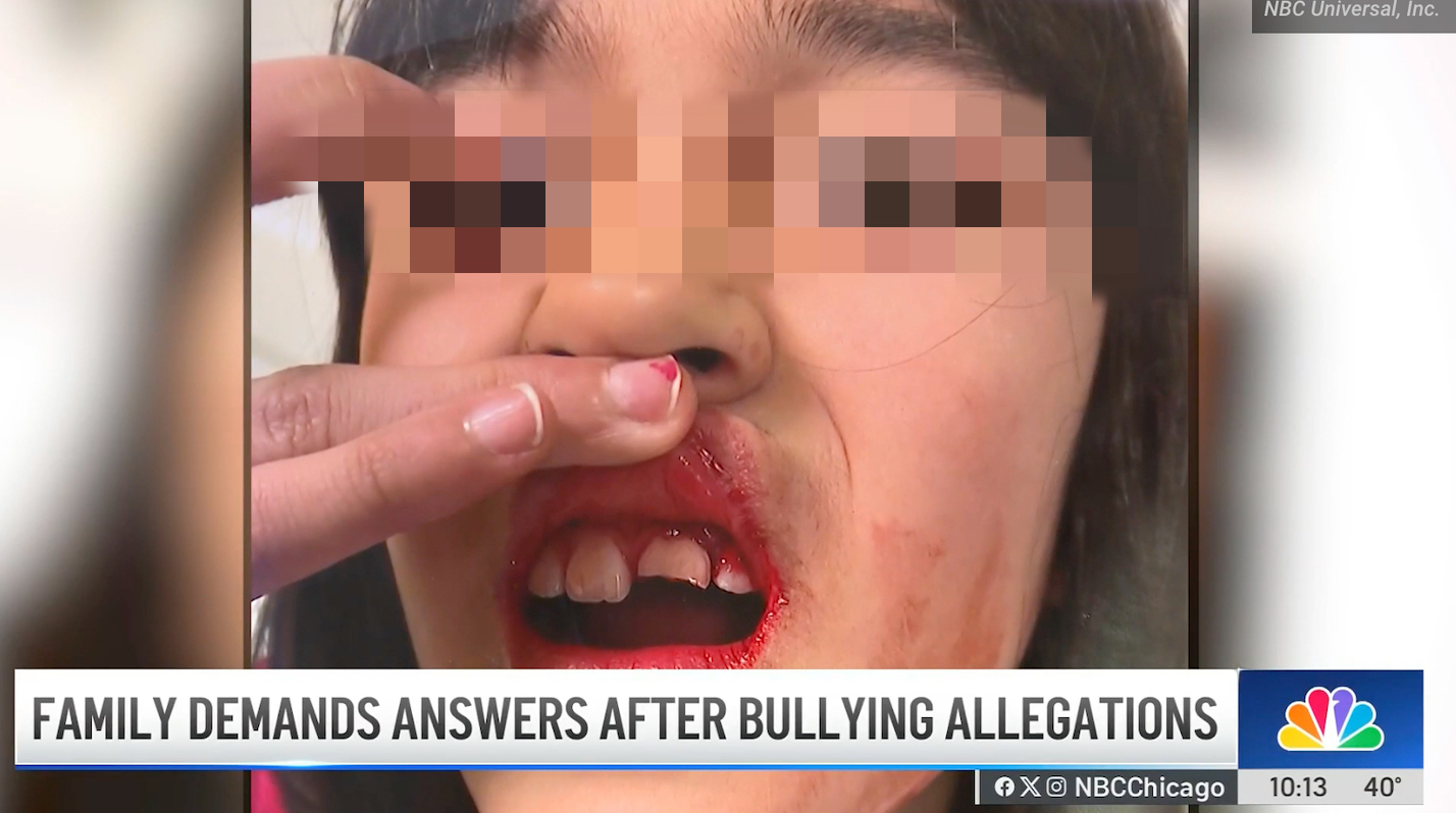 亚裔女童学校遭殴,牙齿永久受损